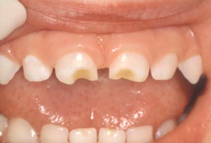 DentalCaries2_LR_521.0