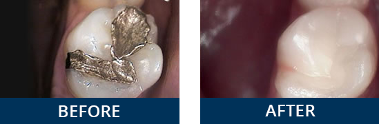composite_tooth_colored_filling