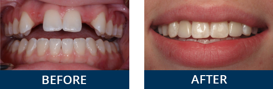 Real patient before and after receiving a smile makeover in Derry, NH.