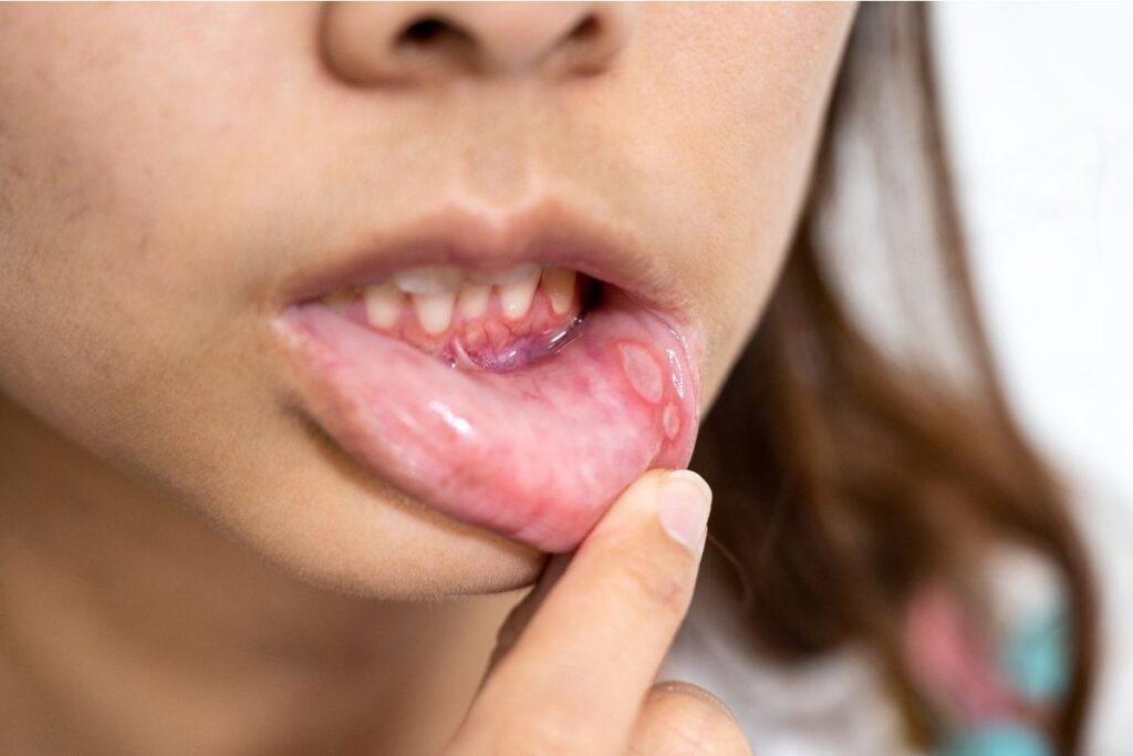 Mouth Sores Hurting? 5 Simple Tips to Heal Faster and Feel Better
