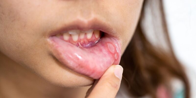 Mouth Sores Hurting? 5 Simple Tips to Heal Faster and Feel Better