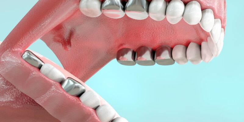 3D dental model showing inflamed gums, metal crowns, and tooth structures against blue background.