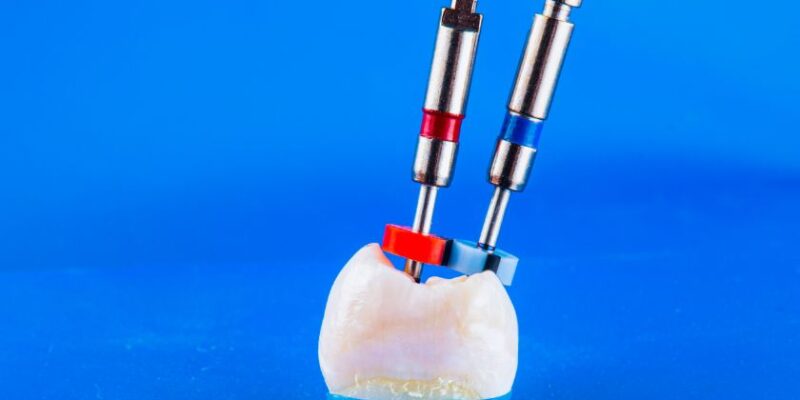 Root Canal Treatment in Derry, NH