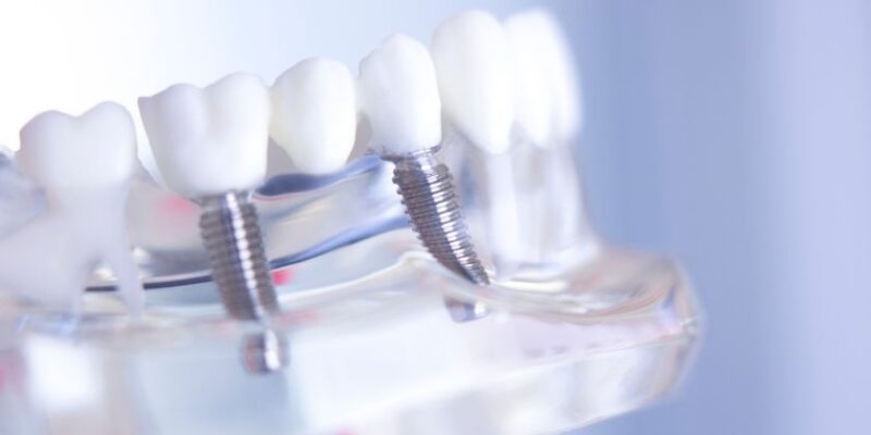 Dental Implants | Vanguard