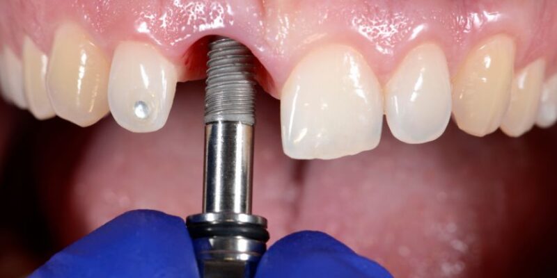 dental implant