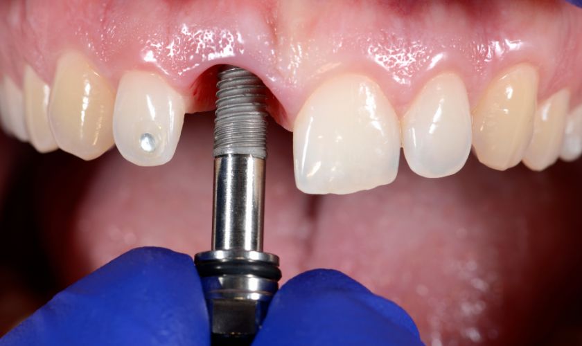 dental implant