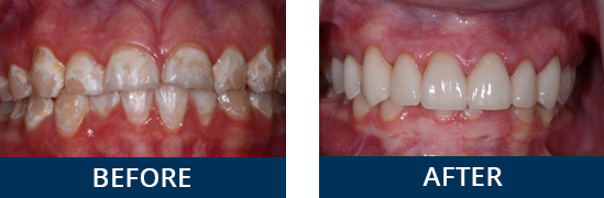 Before and after smile makeover