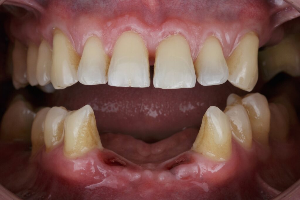 Restoration Dentistry | Best Restoration Options For Missing Teeth