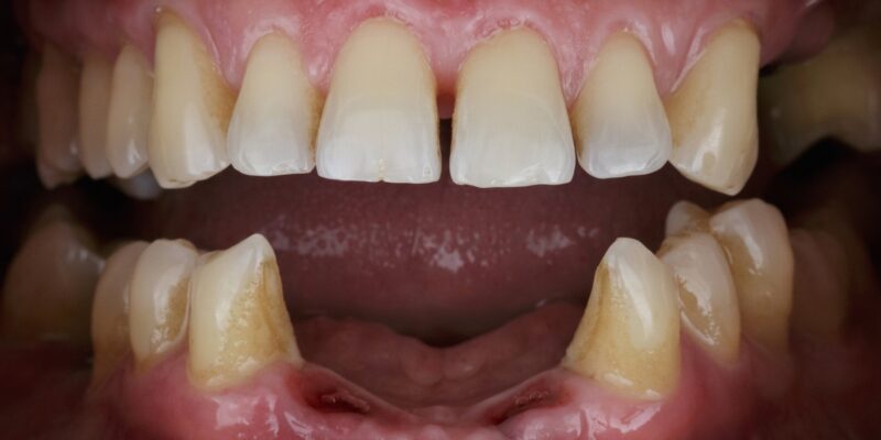 Restoration Dentistry | Best Restoration Options For Missing Teeth