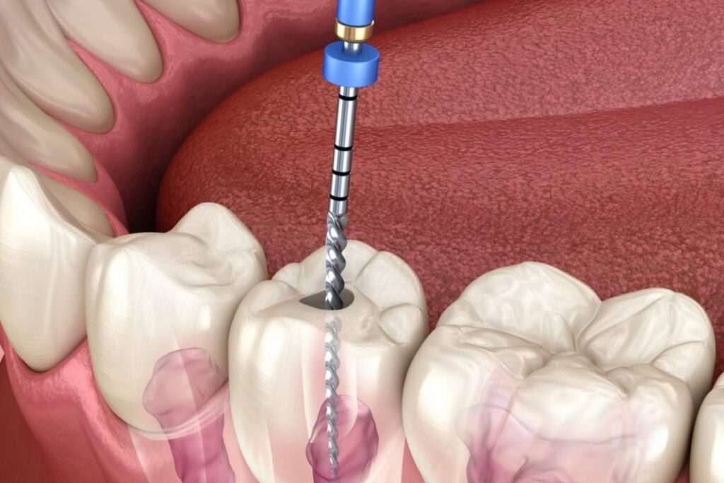 Root Canal | How Root Canals Protect Your Teeth from Decay