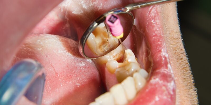 Root Canal | Save Your Tooth Without a Root Canal
