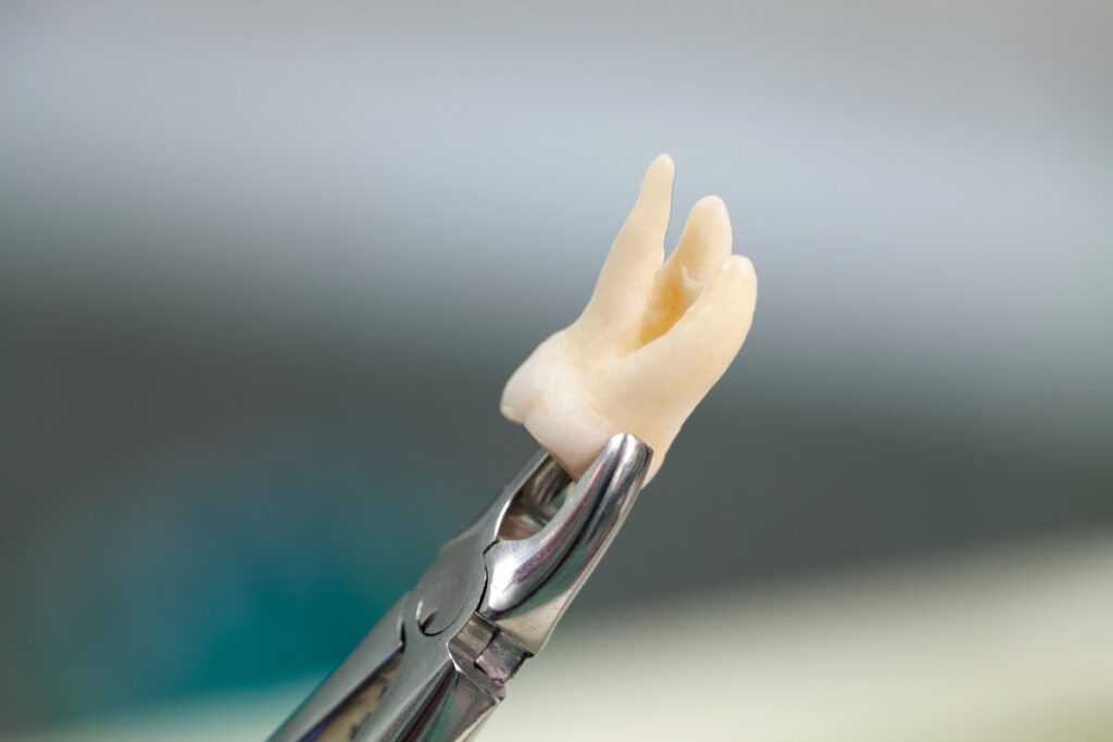 Tooth Extraction | When is tooth extraction considered necessary?