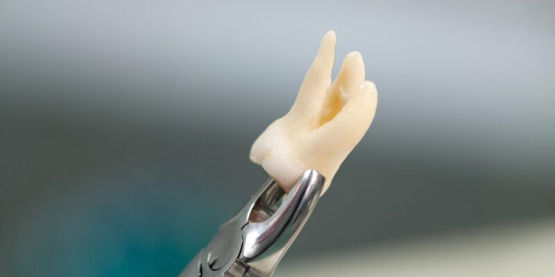 Tooth Extraction | When is tooth extraction considered necessary?