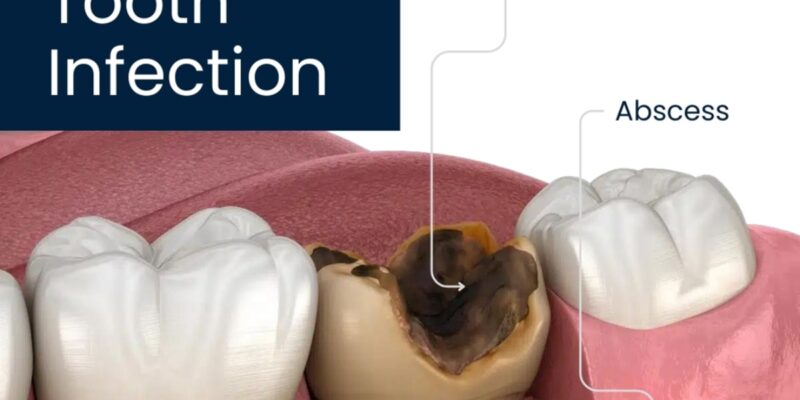 Dentist near me | The Truth About Removing an Infected Tooth