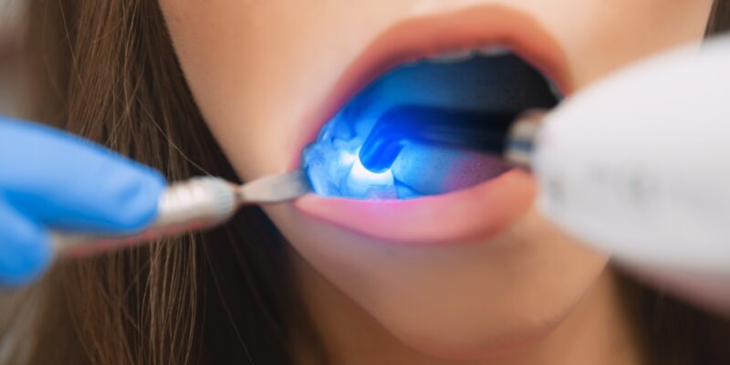 Laser dentistry | Laser Dentistry For Teeth Whitening