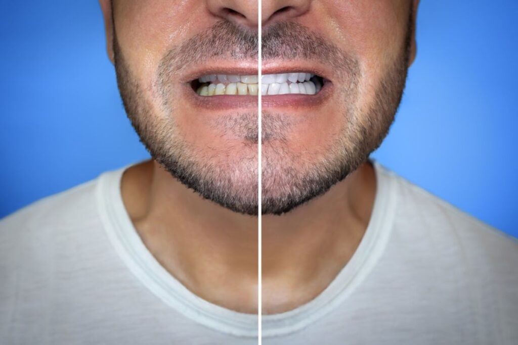 Before and after results of a cosmetic dentistry treatment.
