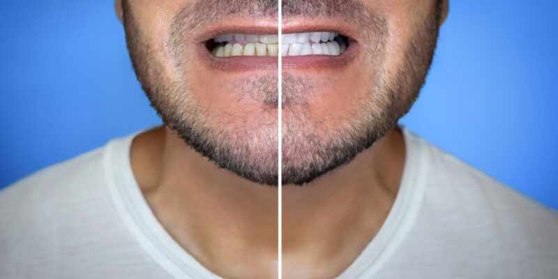 Before and after results of a cosmetic dentistry treatment.