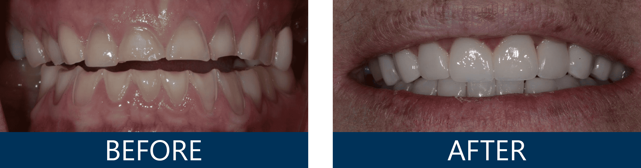 Full Mouth Rehabilitation with Custom Ceramic