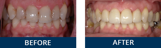 Before and after smile makeover