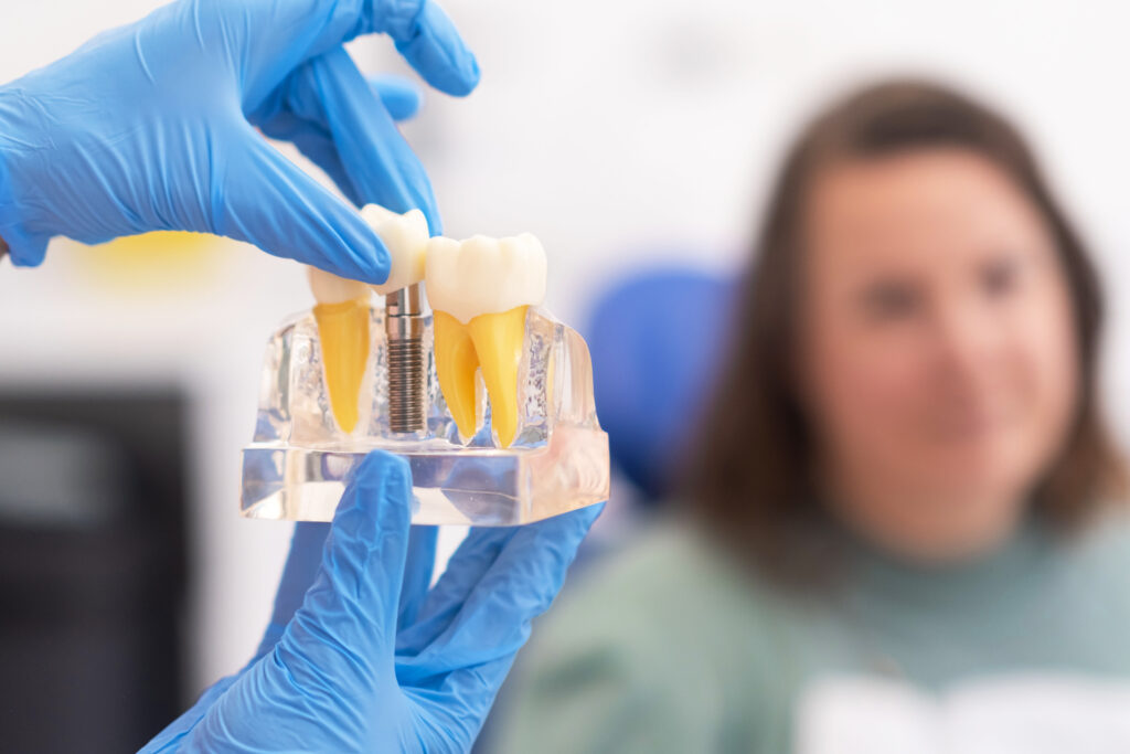 How Long Do Dental Implants Really Last?
