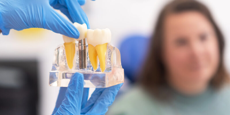 How Long Do Dental Implants Really Last?
