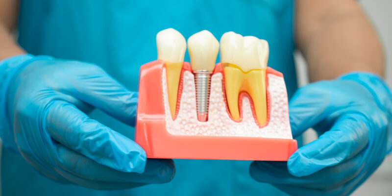 Is Getting a Dental Implant Painful?