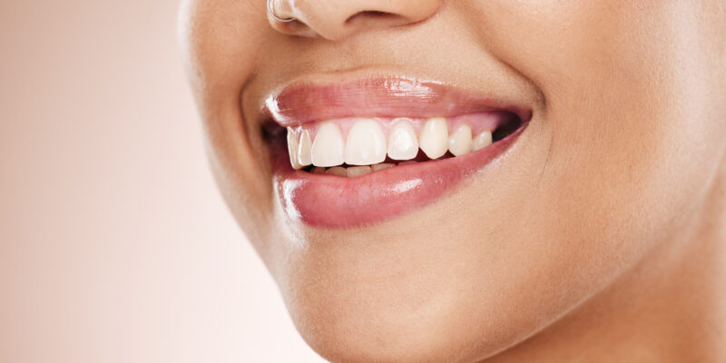 Why Choose a Cosmetic Dentist for Your Smile Makeover?