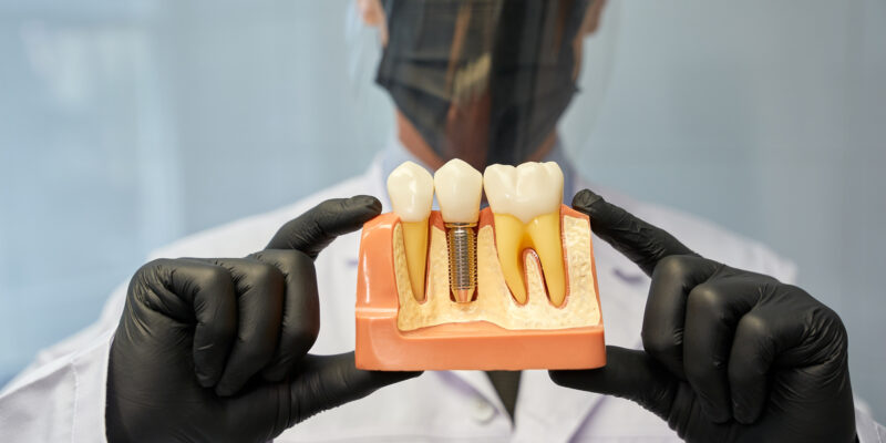 Are Dental Implants Right for You? What to Consider