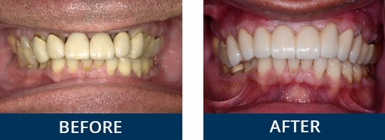 Before and after smile makeover