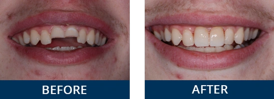 Implant-and-ceramic-crown-to-replace-missing-teeth
