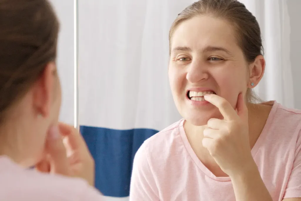 White spots on teeth before porcelain veneer treatment