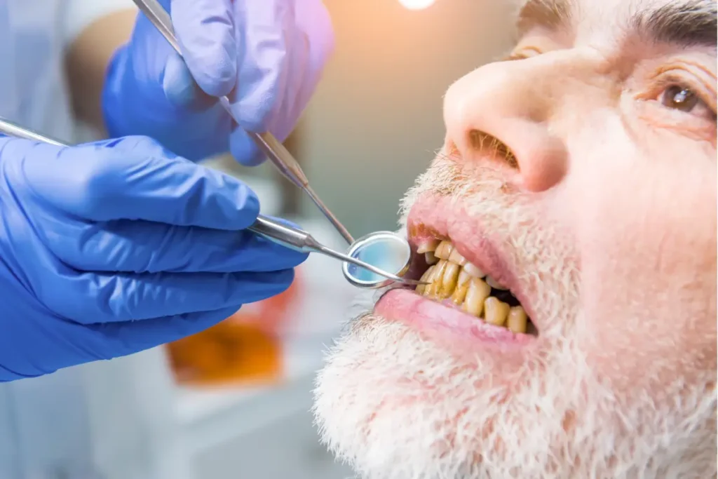 Receding gums exposing tooth roots