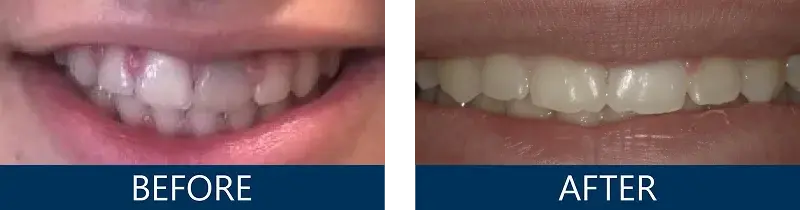 Root Canal & Internal Whitening